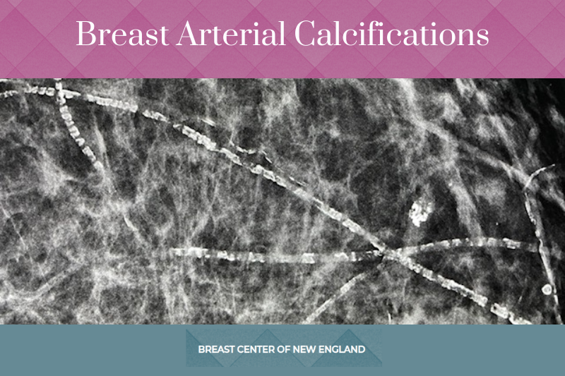 Breast Arterial Calcification